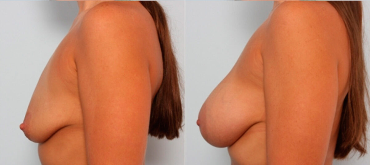 Breast Augmentation before and after photos in Houston, TX, Patient 24864