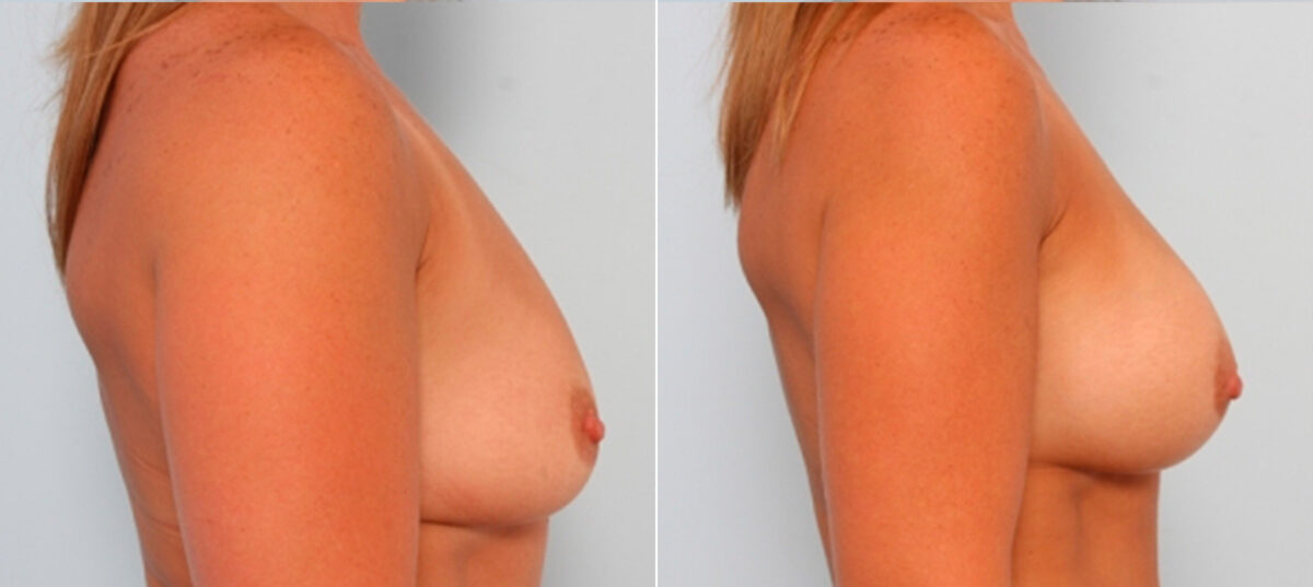 Breast Augmentation before and after photos in Houston, TX, Patient 24897