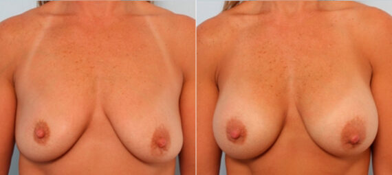 Breast Augmentation before and after photos in Houston, TX, Patient 24897