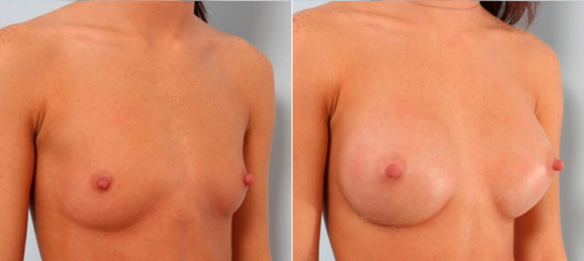 Breast Augmentation before and after photos in Houston, TX, Patient 24908