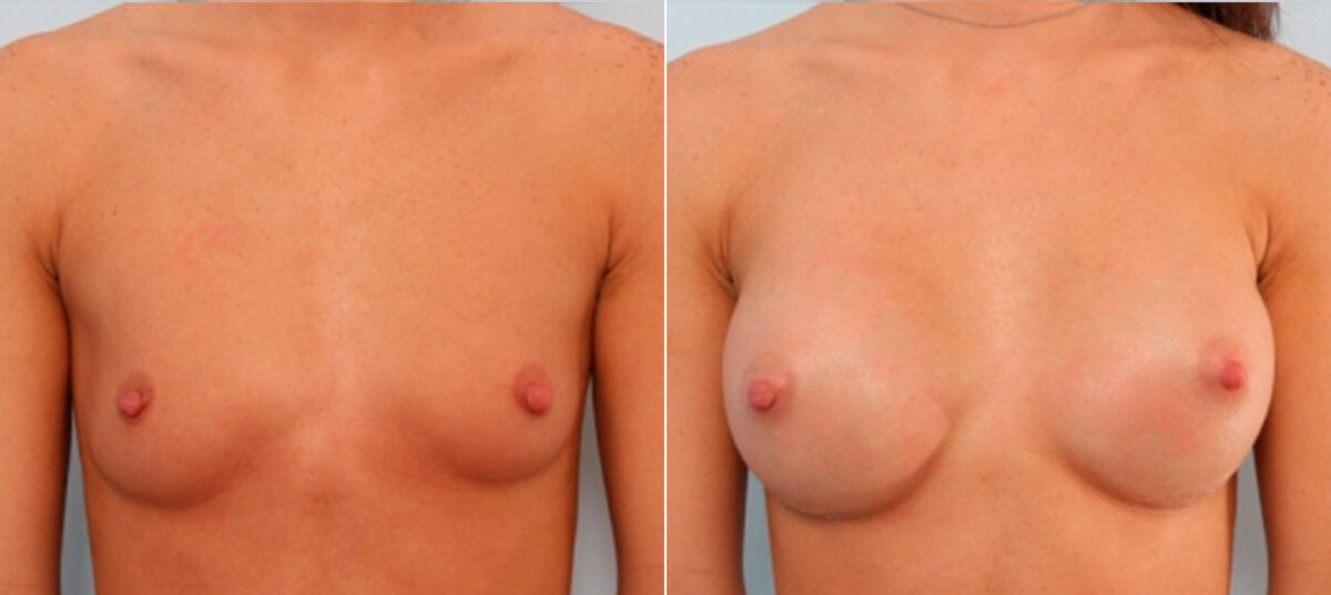 Breast Augmentation before and after photos in Houston, TX, Patient 24908