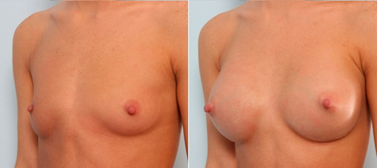 Breast Augmentation before and after photos in Houston, TX, Patient 24908
