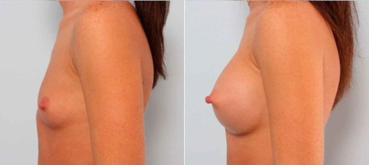 Breast Augmentation before and after photos in Houston, TX, Patient 24908