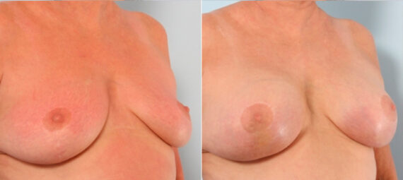 Breast Augmentation before and after photos in Houston, TX, Patient 24919