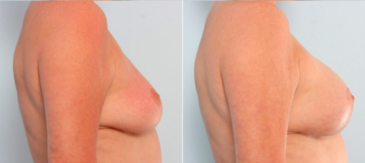Breast Augmentation before and after photos in Houston, TX, Patient 24919