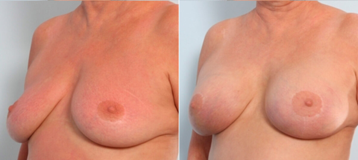 Breast Augmentation before and after photos in Houston, TX, Patient 24919
