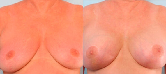 Breast Augmentation before and after photos in Houston, TX, Patient 24919
