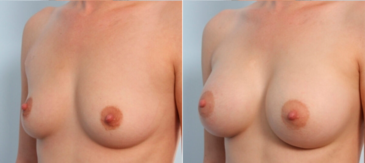Breast Augmentation before and after photos in Houston, TX, Patient 24930