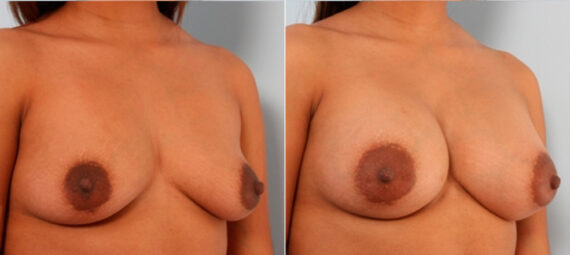 Breast Augmentation before and after photos in Houston, TX, Patient 24941