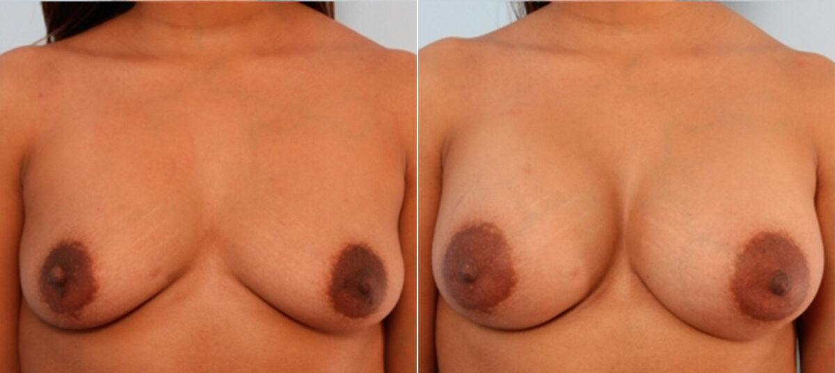 Breast Augmentation before and after photos in Houston, TX, Patient 24941