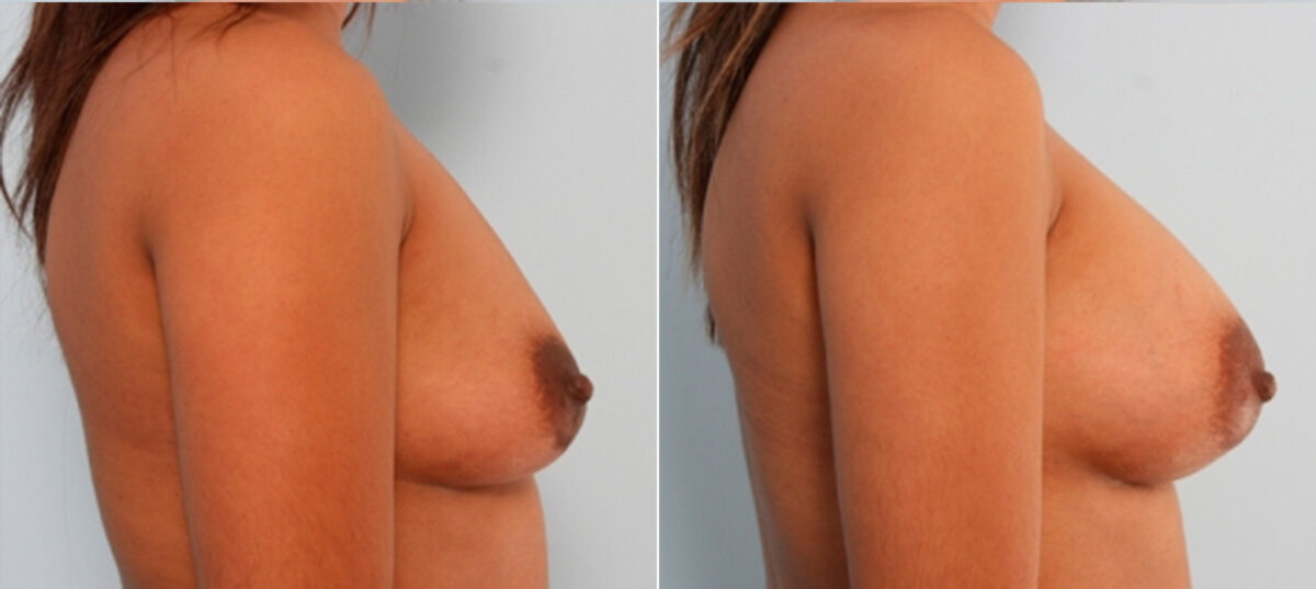Breast Augmentation before and after photos in Houston, TX, Patient 24941