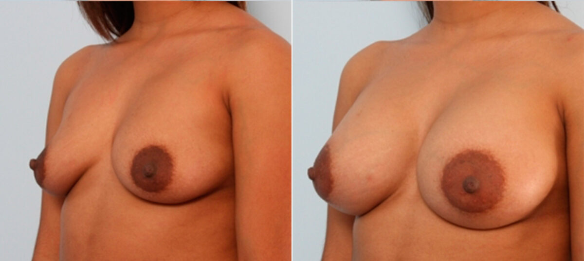 Breast Augmentation before and after photos in Houston, TX, Patient 24941