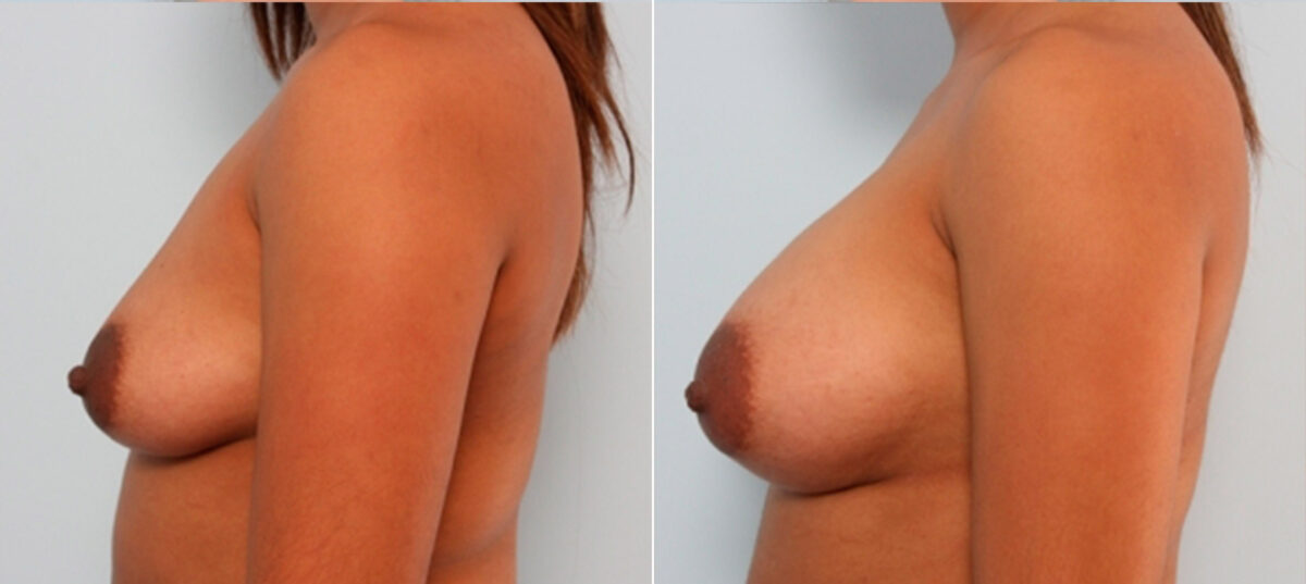 Breast Augmentation before and after photos in Houston, TX, Patient 24941