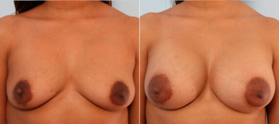 Breast Augmentation before and after photos in Houston, TX, Patient 24941