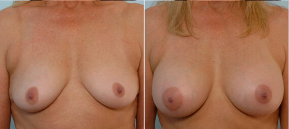 Breast Augmentation before and after photos in Houston, TX, Patient 24974