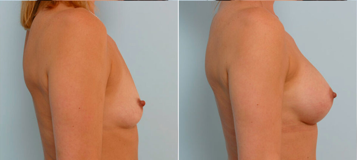 Breast Augmentation before and after photos in Houston, TX, Patient 24981