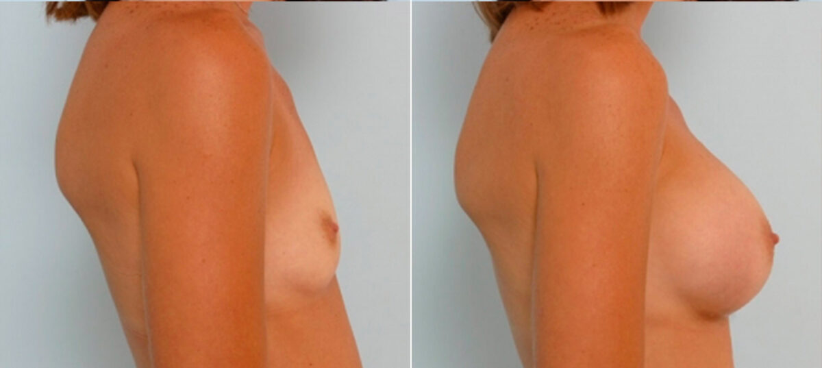 Breast Augmentation before and after photos in Houston, TX, Patient 24988
