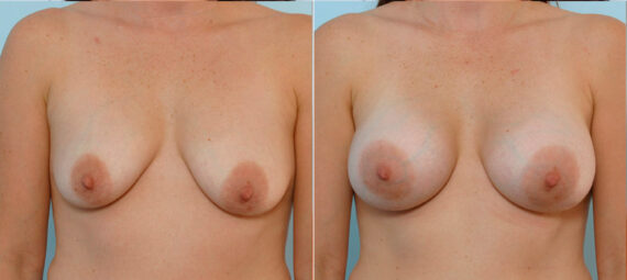 Breast Augmentation before and after photos in Houston, TX, Patient 25002