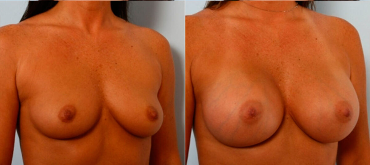 Breast Augmentation before and after photos in Houston, TX, Patient 25009
