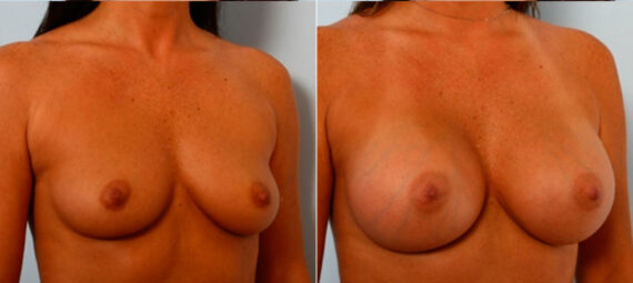 Breast Augmentation before and after photos in Houston, TX, Patient 25009