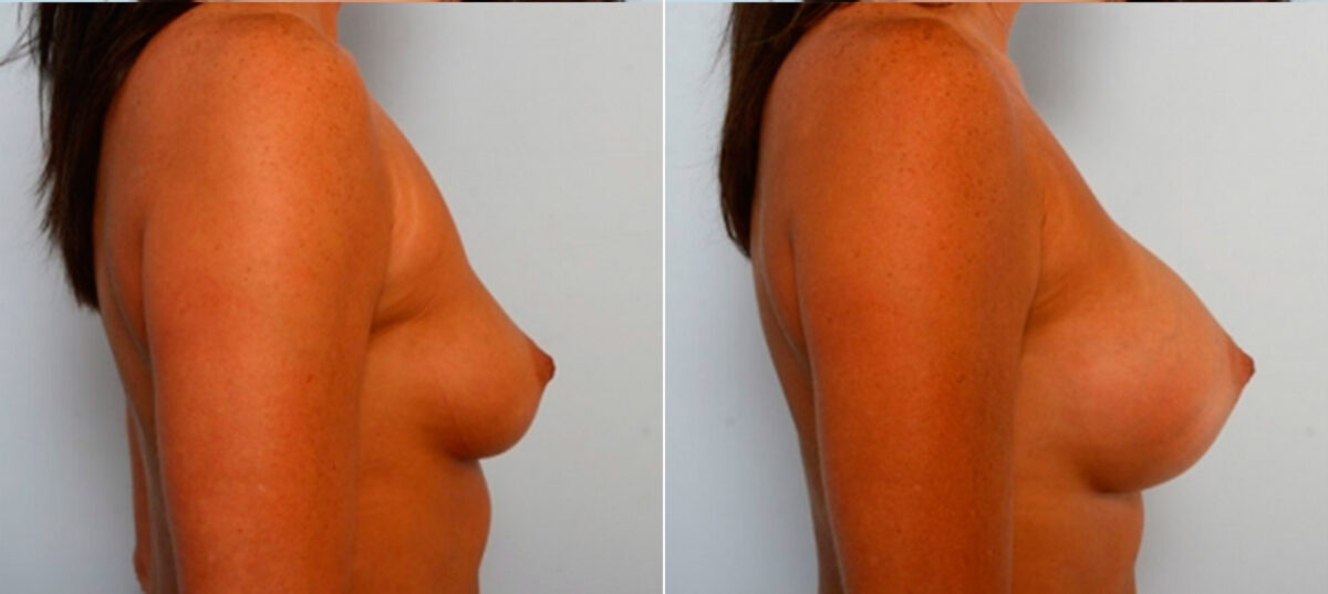 Breast Augmentation before and after photos in Houston, TX, Patient 25009