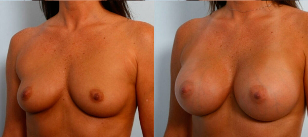 Breast Augmentation before and after photos in Houston, TX, Patient 25009