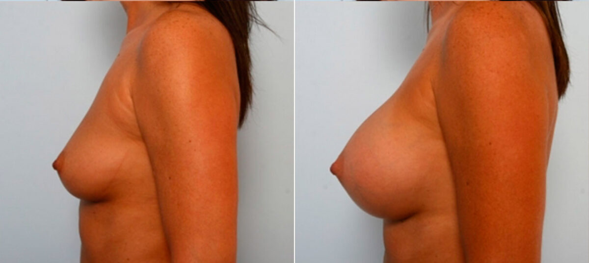 Breast Augmentation before and after photos in Houston, TX, Patient 25009