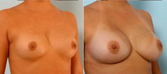 Breast Augmentation before and after photos in Houston, TX, Patient 25031