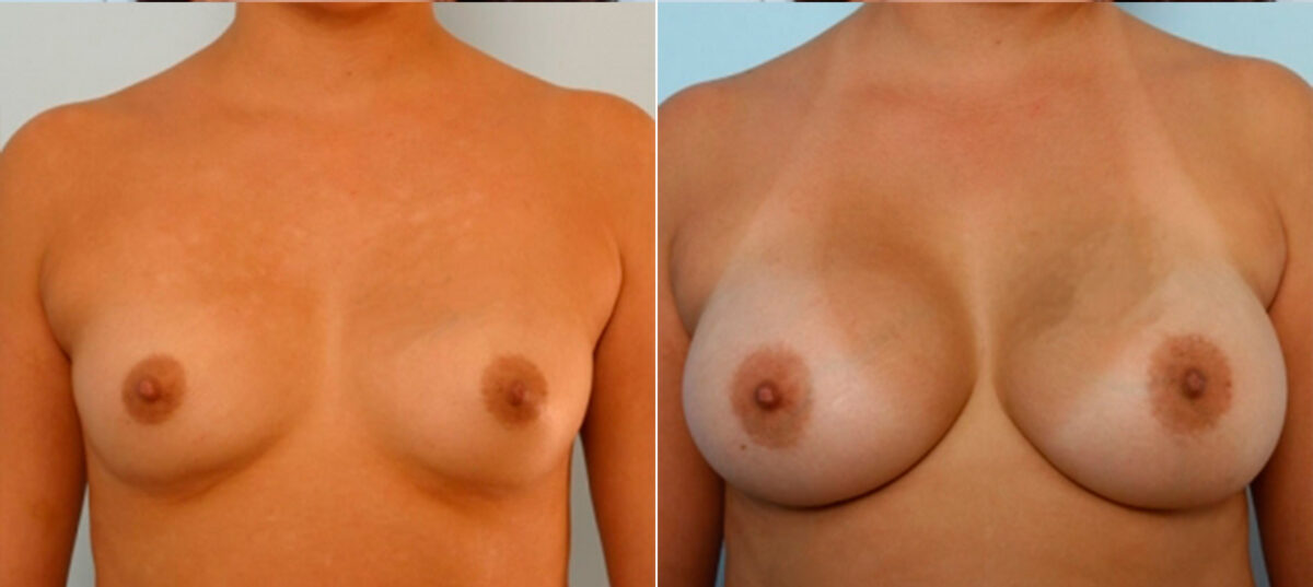 Patient 25031, Breast Augmentation before and after photos Breast Augmentation before and after photos in Houston, TX, Patient 25031