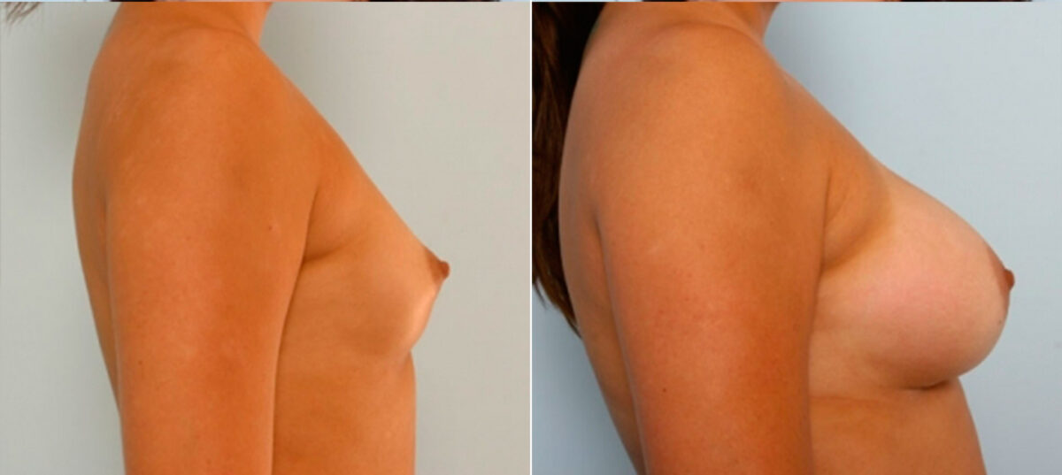 Breast Augmentation before and after photos in Houston, TX, Patient 25031