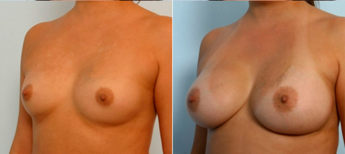 Breast Augmentation before and after photos in Houston, TX, Patient 25031