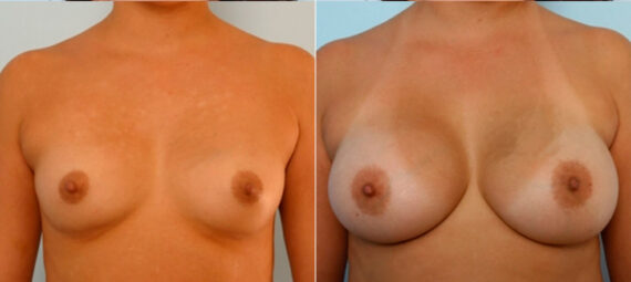 Breast Augmentation before and after photos in Houston, TX, Patient 25031