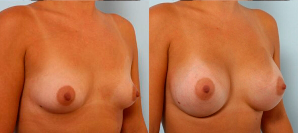 Breast Augmentation before and after photos in Houston, TX, Patient 25042