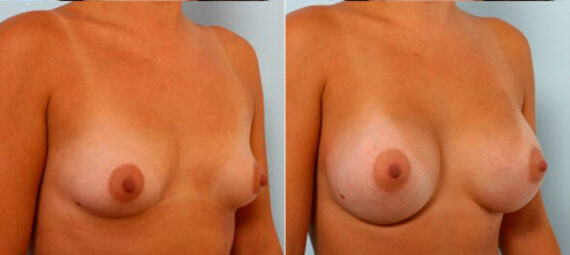 Breast Augmentation before and after photos in Houston, TX, Patient 25042