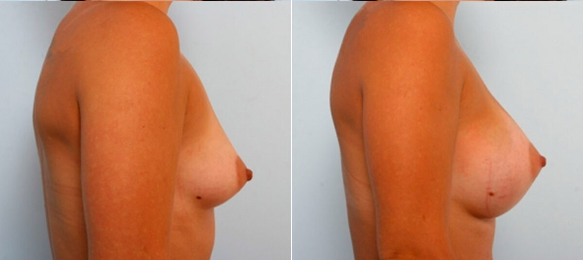 Breast Augmentation before and after photos in Houston, TX, Patient 25042