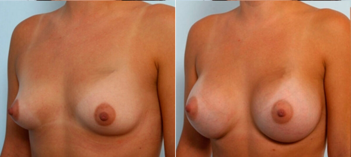 Breast Augmentation before and after photos in Houston, TX, Patient 25042