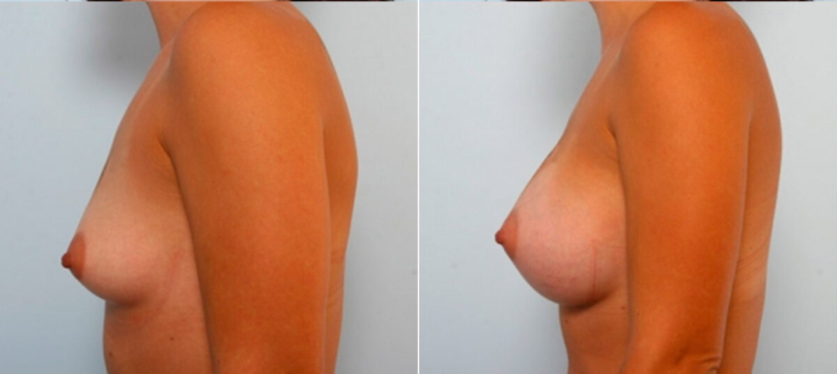 Breast Augmentation before and after photos in Houston, TX, Patient 25042