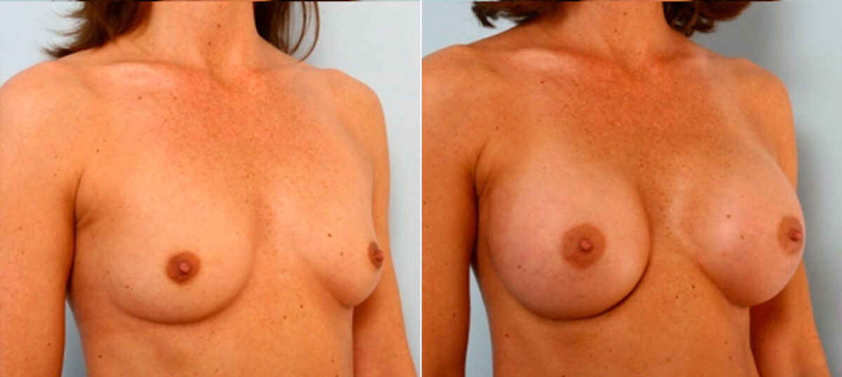 Breast Augmentation before and after photos in Houston, TX, Patient 25053