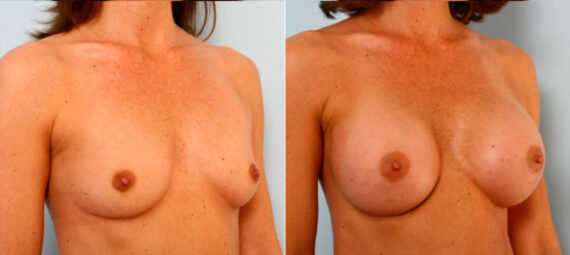 Breast Augmentation before and after photos in Houston, TX, Patient 25053