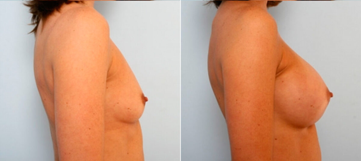 Breast Augmentation before and after photos in Houston, TX, Patient 25053