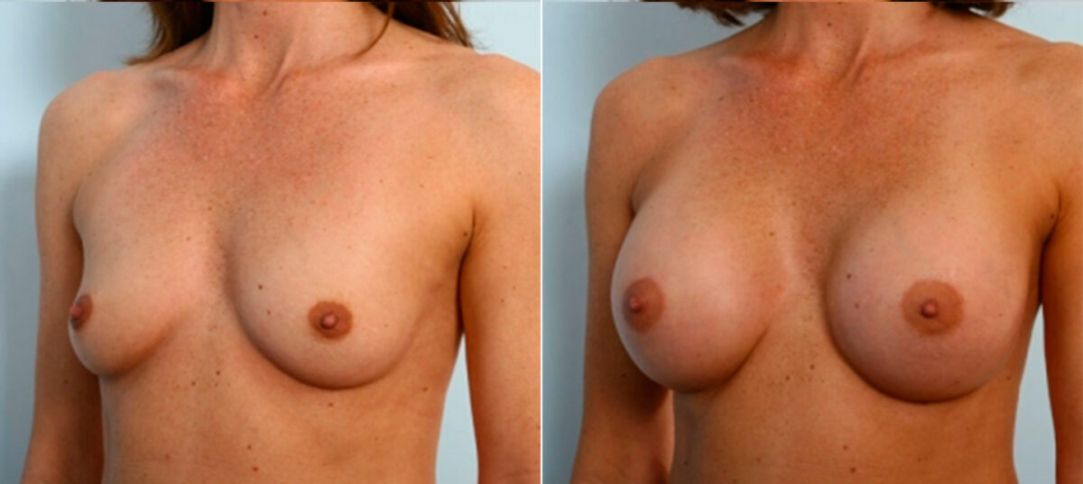 Breast Augmentation before and after photos in Houston, TX, Patient 25053