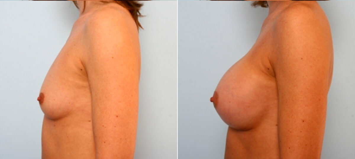 Breast Augmentation before and after photos in Houston, TX, Patient 25053