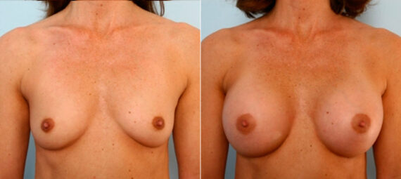 Breast Augmentation before and after photos in Houston, TX, Patient 25053