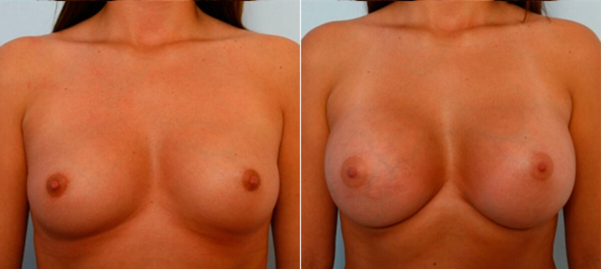 Patient 25064, Breast Augmentation before and after photos Breast Augmentation before and after photos in Houston, TX, Patient 25064