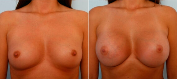 Breast Augmentation before and after photos in Houston, TX, Patient 25064