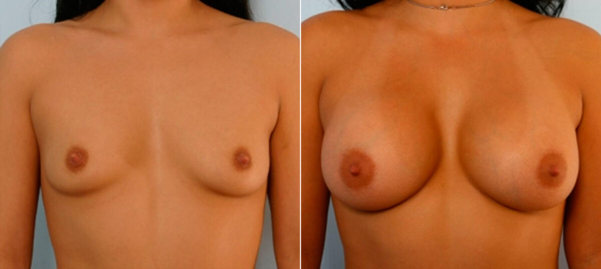 Patient 25075, Breast Augmentation before and after photos Breast Augmentation before and after photos in Houston, TX, Patient 25075