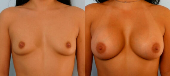 Breast Augmentation before and after photos in Houston, TX, Patient 25075