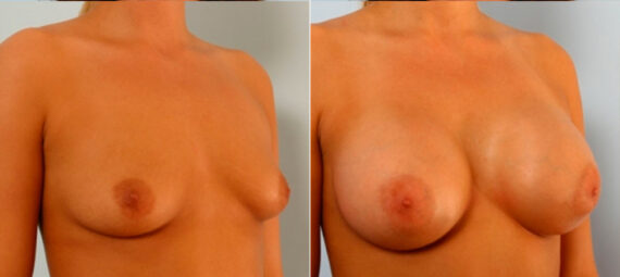 Breast Augmentation before and after photos in Houston, TX, Patient 25086