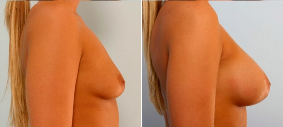 Breast Augmentation before and after photos in Houston, TX, Patient 25086