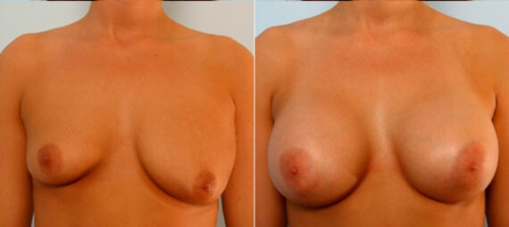 Breast Augmentation before and after photos in Houston, TX, Patient 25086